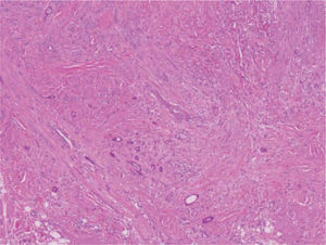 La dermis media está infiltrada por pequeños islotes epiteliales y en la dermis profunda aparecen algunas estructuras tubulares (hematoxilina-eosina, ×20).