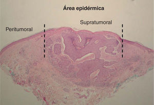 Determinación de células de Langerhans en la epidermis supra y peritumoral (hematoxilina-eosina, ×40).