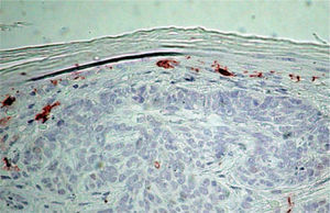 Células de Langerhans CD1a+ en la epidermis supratumoral (CD1a, ×1.000).