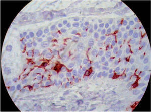 Células de Langerhans CD1a+ en la epidermis peritumoral (CD1a, ×1.000).