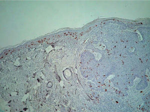 Tinción de células de Langerhans en carcinoma basocelular (CD1a, ×40).