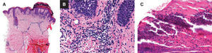 Biopsia en sacabocados, tinción hematoxilina-eosina, ×8. A. Hiperqueratosis con paraqueratosis, hiperplasia epidérmica psoriasiforme, infiltrado en la dermis superior y media, y perifolicular. B y C. A mayor aumento (×15) se puede observar el infiltrado mixto en la dermis y las pústulas espongiformes subcórneas.