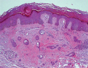 Estructuras ductales en cola de renacuajo en la dermis (hematoxilina-eosina, ×10).
