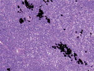Gránulos de pigmento en el interior de los macrófagos y en la región extracelular del ganglio linfático (hematoxilinaeosina, ×10).