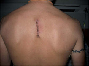 Cicatriz de la ampliación de márgenes de melanoma en la región interescapular. En el brazo derecho se aprecia un tatuaje.