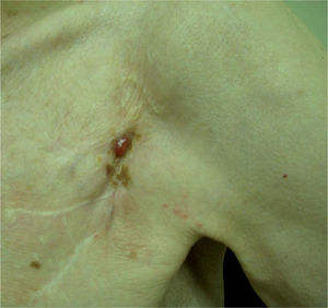 Lesión pápulo-nodular friable, blanda, de 2 × 1 cm en la parte superior de la antigua cicatriz del marcapasos torácico.