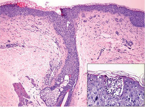 Biopsia cutánea que demuestra múltiples pústulas de localización subcórnea, con áreas de espongiosis focal y un moderado infiltrado linfocitario perianexal (hematoxilina-eosina, ×40; detalle, ×100).