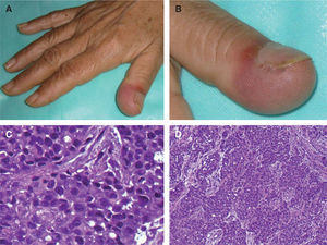 A y B. Engrosamiento e induración del dedo de la mano derecha de coloración violácea. C. Infiltración de la dermis profunda y del tejido celular subcutáneo por células atípicas dispuestas en patrón trabecular (hematoxilina-eosina, ×40). D. Las trabéculas están separadas por bandas de tejido fibroso (hematoxilina-eosina, ×100).