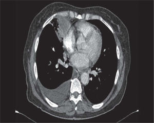 Imagen de la tomografía axial computarizada (TAC) que muestra la presencia de una masa pulmonar solitaria.
