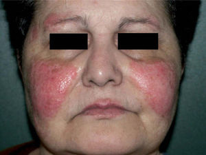 Placas eritematosas infiltradas de borde neto en las cejas, las mejillas y la piel del labio superior.