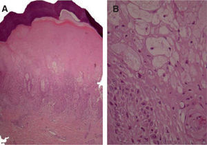 Degeneración vacuolar epidérmica (A) y detalle de las vesículas intra e intercitoplasmáticas secundarias a la progresiva espongiosis (B).
