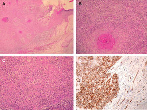 A. Lesión tumoral endofítica en conexión con la epidermis (hematoxilina-eosina, ×40). B. Células con citoplasma claro y queratinización tricolemal (hematoxilina-eosina, ×100). C. Membrana gruesa en la profundidad de los lóbulos tumorales. Células claras con pleomorfismo nuclear y figuras de mitosis (hematoxilina-eosina, ×200). D. Positividad con CD34 en las membranas celulares y en los endotelios vasculares (control interno) (CD34, ×200).