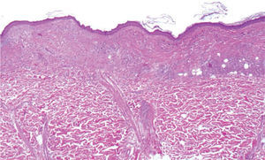 Imagen panorámica de un melanoma con regresión avanzada (hematoxilina-eosina, ×40).