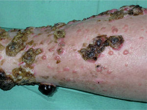 Metástasis en tránsito en un paciente con melanoma primario localizado en la extremidad inferior. Imagen cedida por el Prof. Carlos Ferrándiz Foraster, Hospital Germans Trias i Pujol (Badalona).