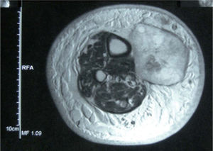 Resonancia magnética con gadolinio de metástasis en tránsito subcutánea localizada en la región tibial. La infiltración del paquete vásculo-nervioso tibial posterior y la musculatura adyacente, así como un diámetro superior a 5 cm, marcan el límite de irresecabilidad de la lesión.