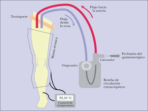 Esquema del circuito de circulación extracorpórea establecido para la perfusión del miembro aislado.