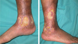 Úlceras dolorosas bien delimitadas localizadas en la región perimaleolar derecha.