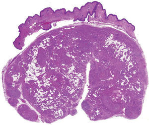 Caso 1. Tumor bien delimitado, en el límite dermo-hipodérmico, compuesto por músculo liso, grasa y abundantes vasos sanguíneos (hematoxilina-eosina, ×20).