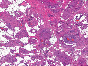 Caso 1. Detalle de los tres componentes del tumor: grasa, músculo liso y vasos sanguíneos (hematoxilina-eosina, ×200).