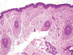 Folículos pilosos en la dermis superficial, con un estroma celular. Hematoxilina-eosina, ×10.