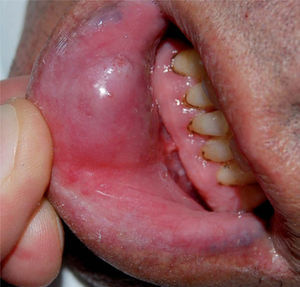 Nódulo violáceo, de 2cm de diámetro, en la mucosa de labio inferior.