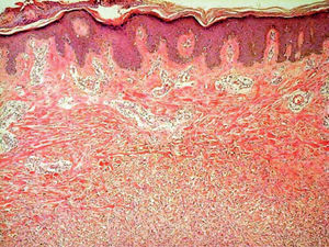 Histiocitos y abundantes fibroblastos entre haces gruesos de colágeno en la dermis media y profunda, respetando una estrecha banda superficial (hematoxilina-eosina, x100).