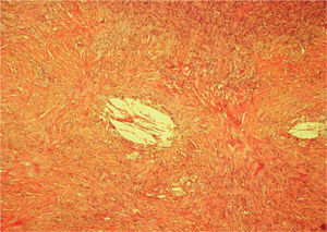 En la dermis media y profunda se aprecian depósitos de cristales fusiformes biconvexos de colesterol, agrupados y rodeados de histiocitos, con proliferación de fibroblastos y haces gruesos de colágeno (hematoxilina-eosina, x200).