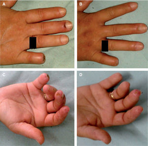 Aspecto de las lesiones (caso 1) antes (A y C) y después del tratamiento con sildenafilo (B y D).