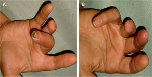 Aspecto de las lesiones (caso 2) antes (A) y después del tratamiento con sildenafilo (B).