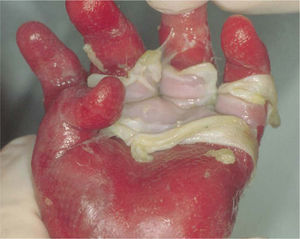 Epidermólisis letal acantolítica debida a una mutación de la desmoplaquina. Se observa desprendimiento epidérmico total en forma de guante.