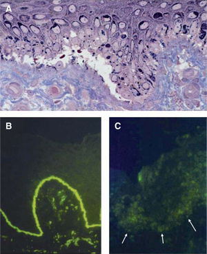 Hallazgos histológicos de las epidermólisis ampollosas en la piel. A. Corte semifino para microscopía electrónica teñido con azul de metileno y Azure II (60x). En la epidermólisis ampollosa simple existe una ampolla dentro de la célula basal epidérmica, por encima de la unión dermo-epidérmica. B. Mapeo por inmunofluorescencia en piel normal (40x) que muestra la presencia de colágeno tipo VII. C. Piel de paciente con epidermólisis ampollosa distrófica recesiva grave, en la que no se observan rastros de colágeno tipo VII por medio del autoanticuerpo contra dicho componente de las fibrillas de anclaje (40x).