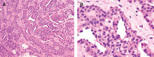 Hematoxilina-eosina. A. Típico tumor glómico con estructuras vasculares rodeadas de células glómicas (glomangioma) (× 40). B. Detalle de las células glómicas rodeando las estructuras vasculares (× 100).