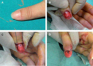 Extirpación quirúrgica «a ciegas» mediante abordaje transungueal en el primer dedo de la mano izquierda.