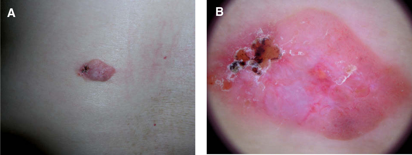 Fep Derm Fibroepitelioma de Pinkus. Descripción dermatoscópica de 3 casos ...