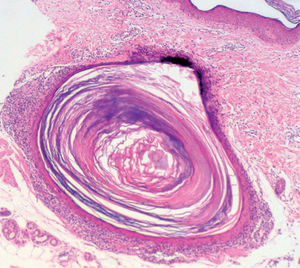 Alrededor de los microquistes infundibulares comedonianos se observa un infiltrado linfoide con un patrón claramente liquenoide. Hematoxilina-eosina, ×10.