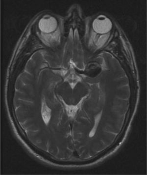 Vacío de señal en la resonancia magnética nuclear en la región de la arteria cerebral media izquierda. Aneurisma fusiforme gigante (2,5cm).