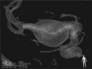 Imagen en 3D en la que se aprecian la prótesis endovascular Enterprise y la espiral Matrix2 que ocasionan la oclusión del aneurisma por formación de coágulo y fibrosis.