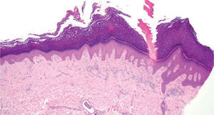 Imagen histológica teñida con hematoxilina-eosina. Presencia de hiperqueratosis ortoqueratósica que rodea a un área paraqueratósica intensamente eosinófila (×40).