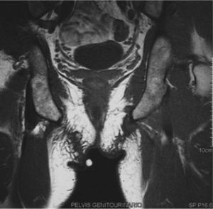 Resonancia magnética nuclear (marcador cutáneo sobre la lesión estudiada): nódulo en la región perineal derecha, hipointenso en las secuencias T1.