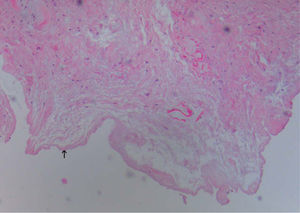 Cavidad quística recubierta por un material fibrinoide (↑) y desprovista de revestimiento epitelial. Por debajo, tejido conjuntivo laxo paucicelular con cambio mixoide. (Hematoxilina-eosina, ×20).
