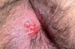 Placa eritemato-rosada verrugosa, con múltiples lesiones polipoideas de aspecto muy vascularizado en su superficie, localizada en la región perianal.