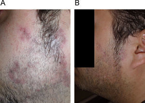 A) Placas eritematovioláceas con discreta atrofia central en la región preauricular izquierda. Pretratamiento. B) Resolución de las lesiones tras el tratamiento.