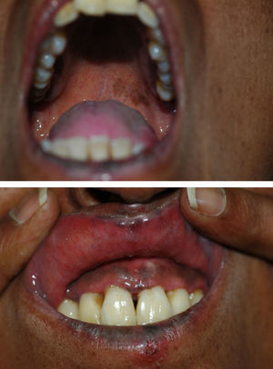Mácula hiperpigmentada en la mucosa del paladar. Hiperpigmentación de la mucosa gingival.