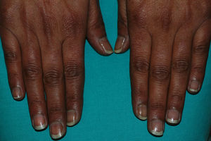 Hiperpigmentación ungueal y del dorso de las manos.