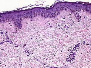 En el estudio histopatológico se observa una hiperpigmentación de la capa basal de la epidermis y presencia de numerosos melanófagos dérmicos (hematoxilina-eosina × 100).