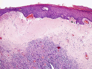 Hematoxilina-eosina 20x. Esclerosis de los haces de colágeno en forma de banda en la dermis superficial con infiltrado linfoide en la zona de la dermis profunda. Epidermis con leve hiperqueratosis paraqueratósica.