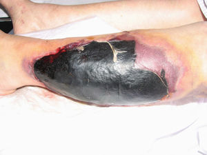 Hematoma de gran tamaño localizado en la pierna derecha con escara necrótica superficial.