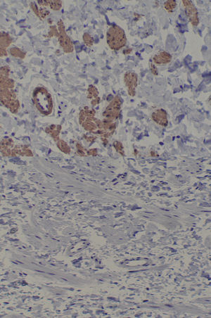 Inmunofluorescencia positiva para actina de músculo liso (parte superior de la imagen). Detalle en la parte inferior de inmunorreactividad negativa para receptores de andrógenos.