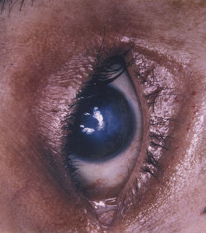 En algunos casos pueden aparecer úlceras corneales que evolucionan hacia opacidades.