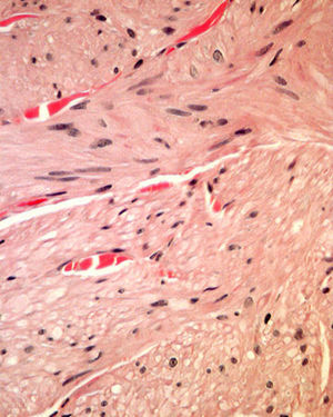 Haces formados por células fusiformes de citoplasma eosinófilo y núcleos alargados de bordes romos. Hematoxilina-eosina, ×20.